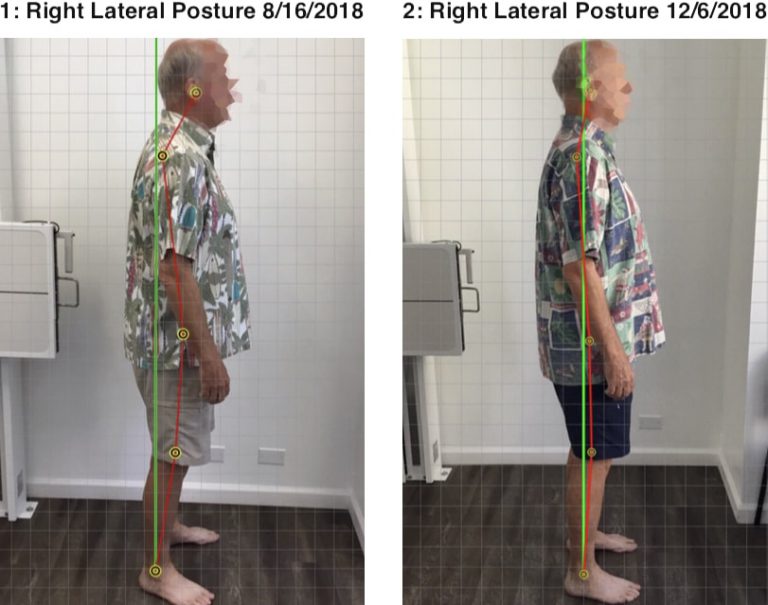 Corrective chiropractic care for posture correction in Honolulu, HI