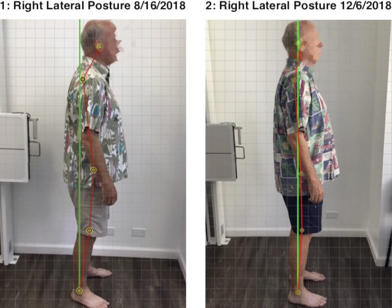 Corrective chiropractic care for posture correction in Honolulu, HI