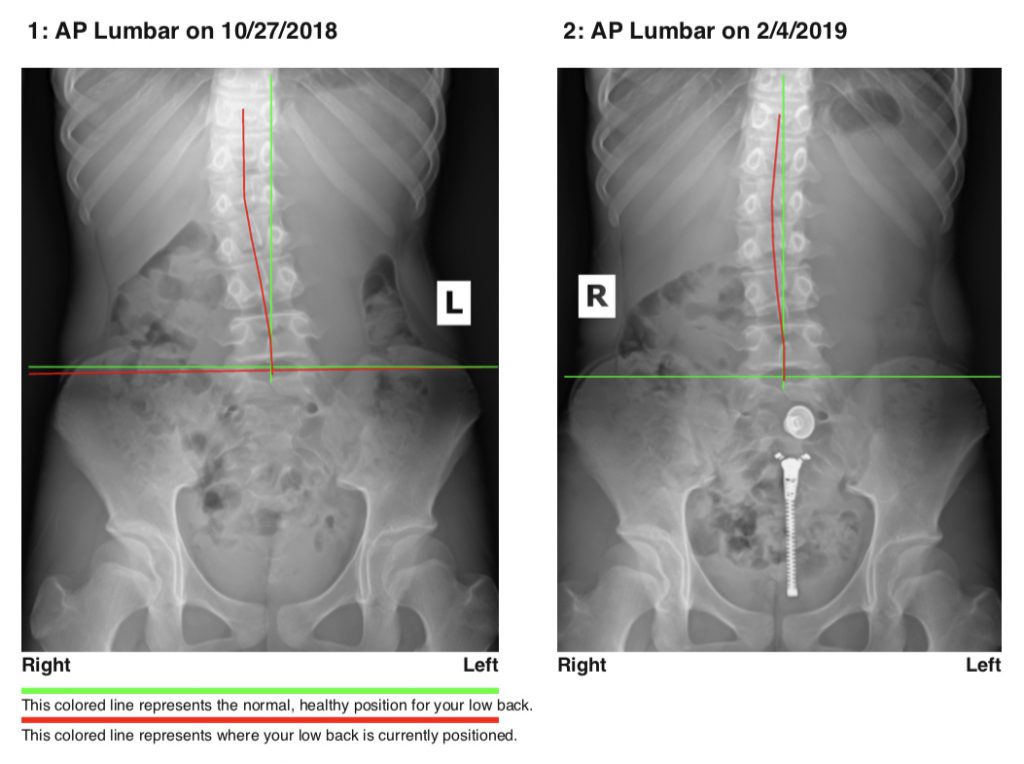 Lower back postural correction after 3 months with Chiropractic BioPhysics treatments in Honolulu, HI