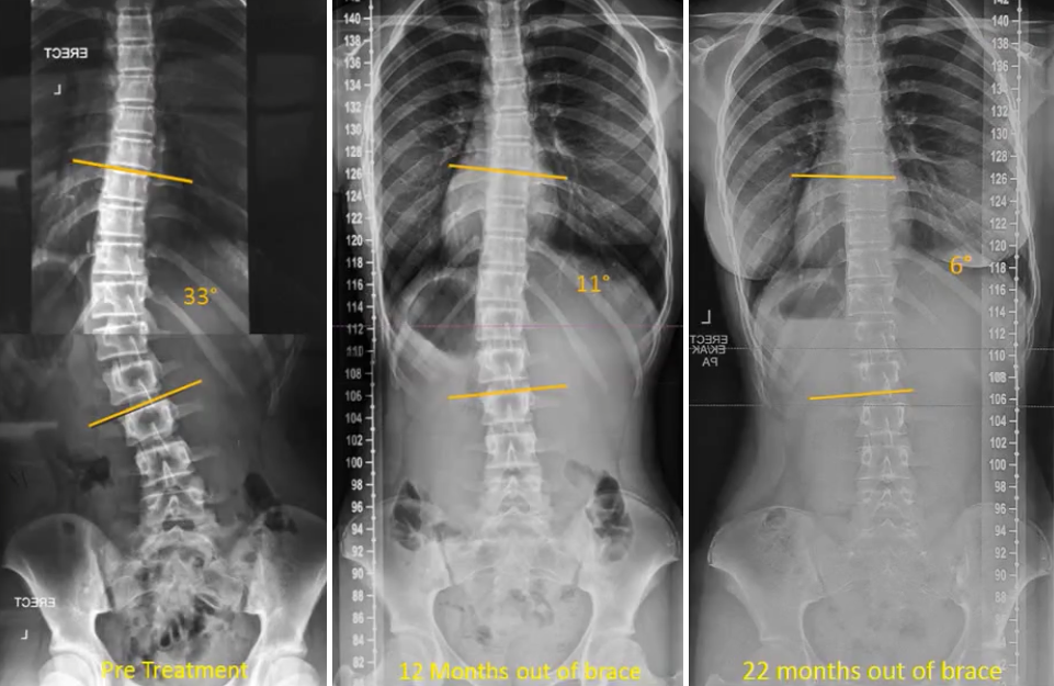 Scoliosis Brace