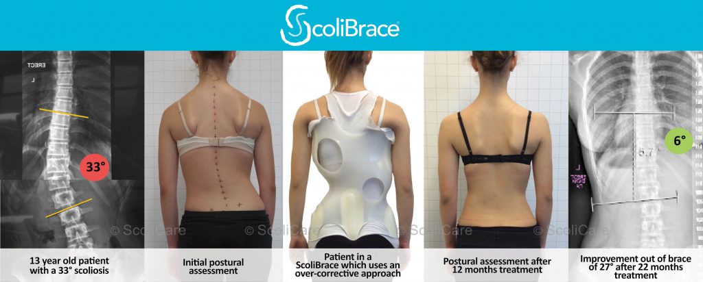 Before and after treatment with ScoliBrace back brace for scoliosis