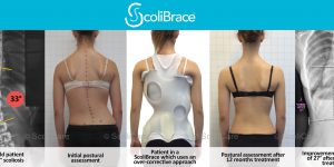 Before and after treatment with ScoliBrace back brace for scoliosis