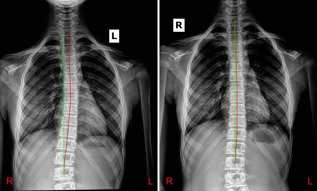 Postural correction after 4 months of Chiropractic BioPhysics treatment