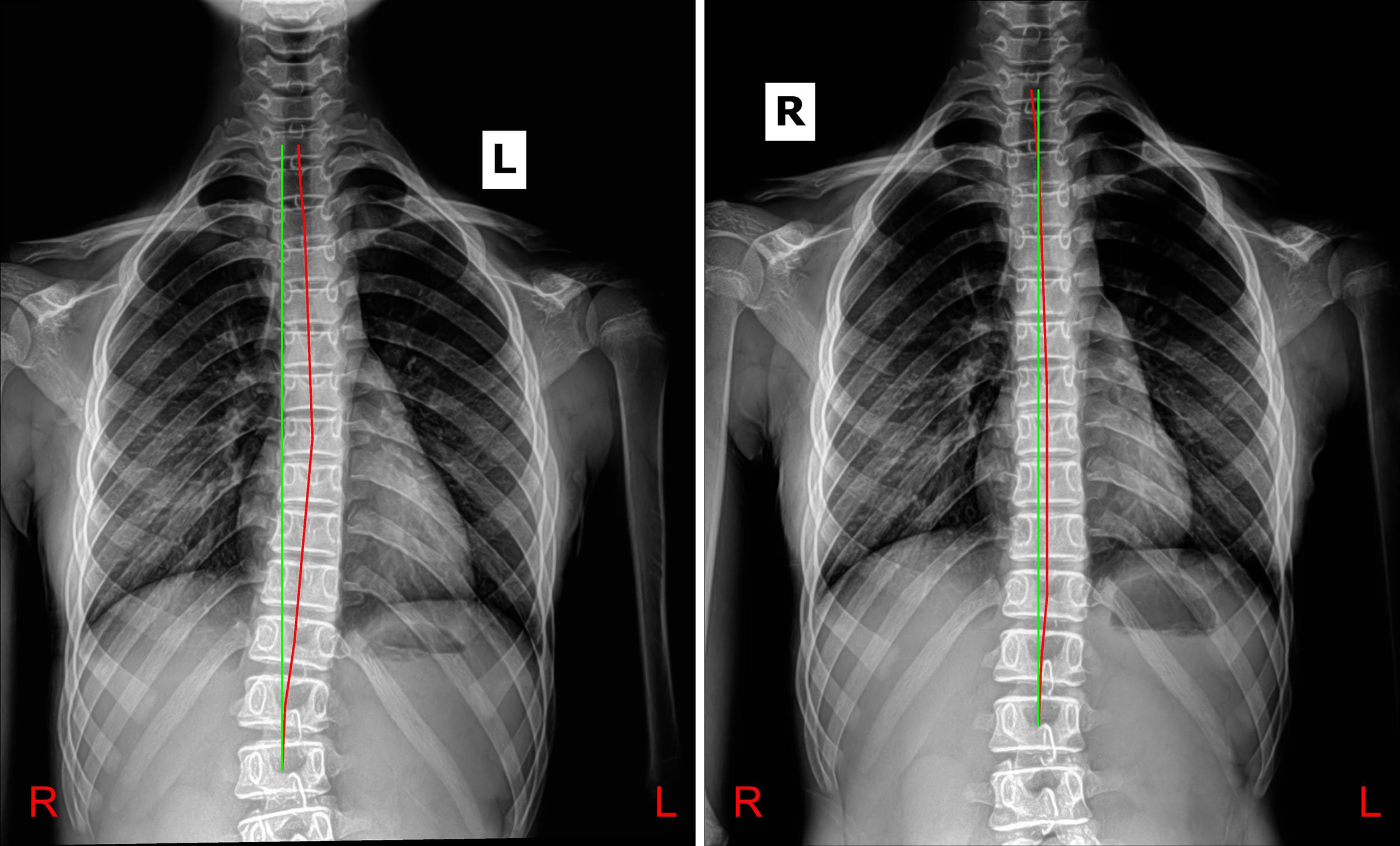 Chiropractic Biophysics Foundation Spine And Posture