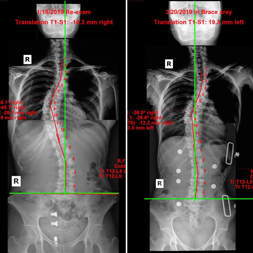 adult scoliosis brace x-ray