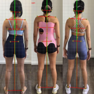 before and after scoliosis bracing treatment